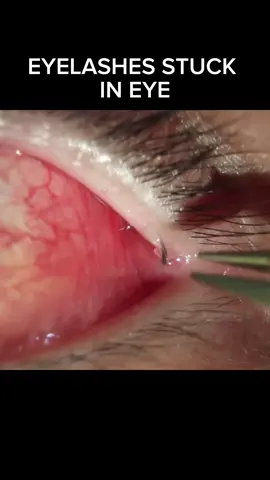 Narh theres no way that can happen #CapCut#newfearunlocked #eye #eyelashes #odlysatisfying #stuck #3am #fyp #dr 