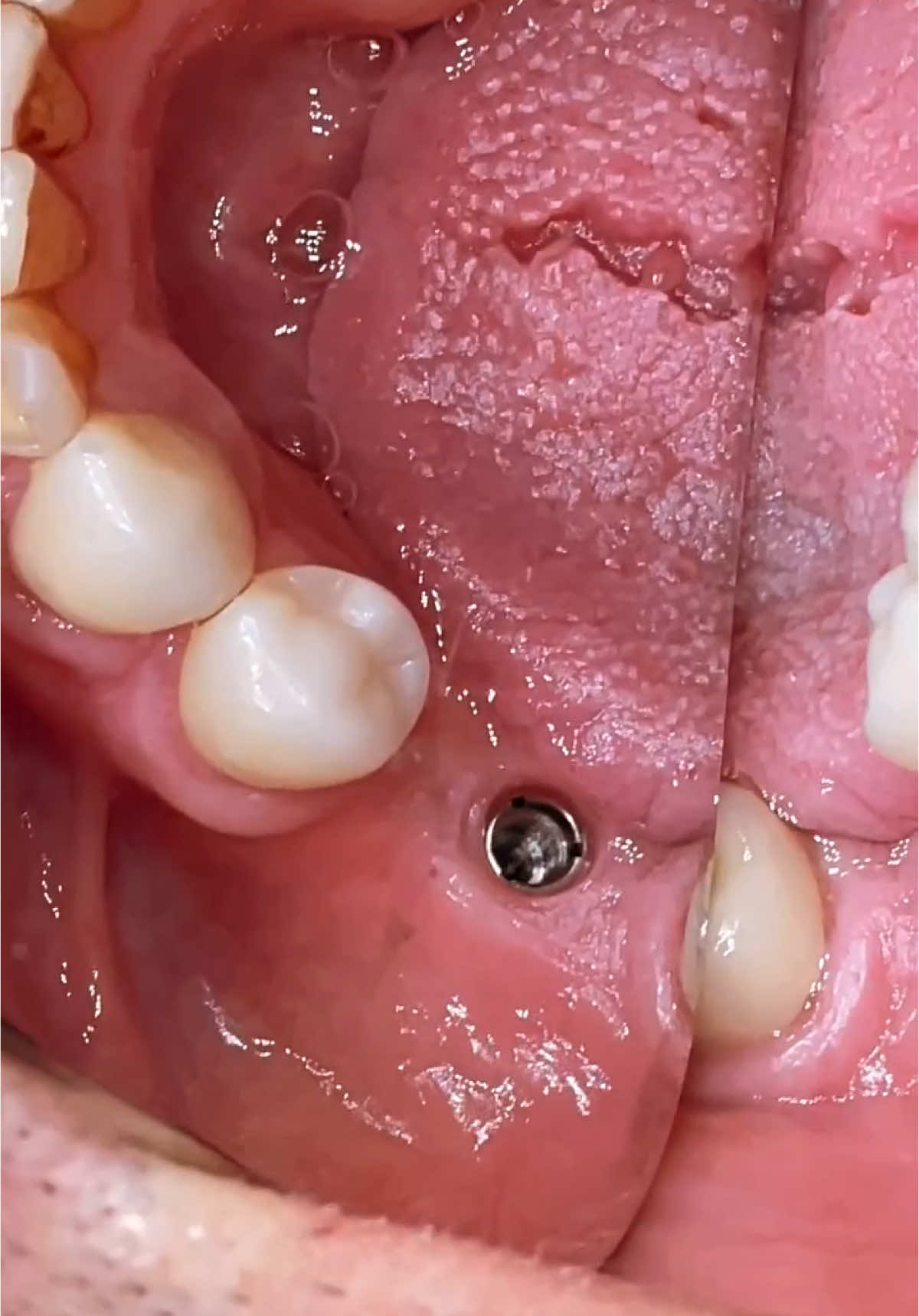 Sequence of crown placement on implant. #implant #crown #implantologist #implantology #dentalsurgery #zirconias #dentist #dentistas #dentistas #implantologie #tandarts #tooth #dentistry #zirconia #tandarts #implantologie #implantologia #fy #fyp #fypage #fyppppppppppppppppppppppp #fypシ゚ #fypp #viral #viralvideo #viraltiktok #foryou #fouryou #fouryoupage #foryoupage #howto #tooth #tiktok #tiktokdentist #morocco #morocco🇲🇦 #morocco🇲🇦المغاربة 