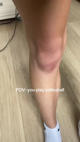 I think I need some new kneepads 🤣 #volleyball #kneepads #bruises #relateable #sport #fy #fyp #fyppppppppppppppppppppppp 