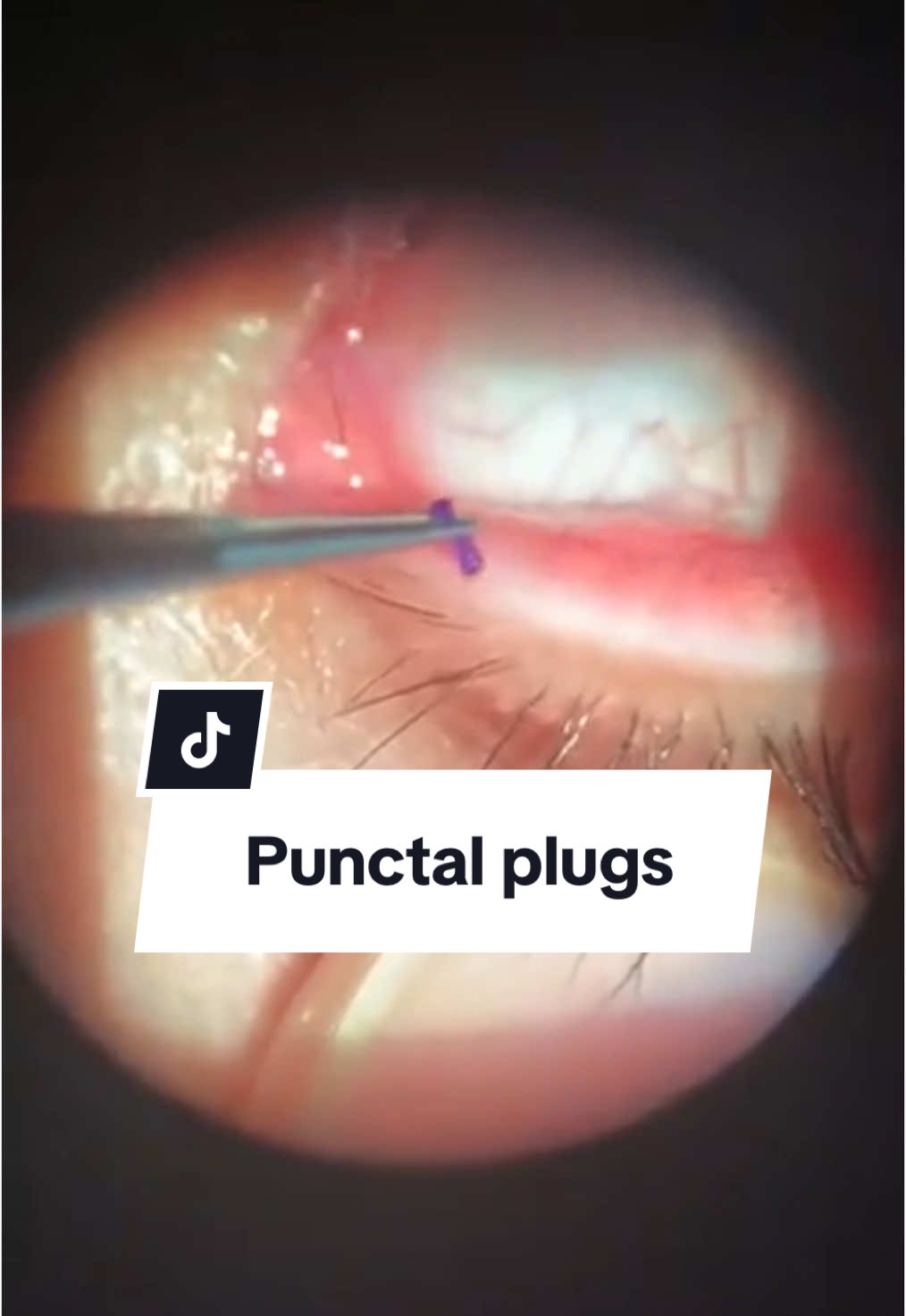 #stitch with @The Human Body #punctalplugs #dryeyes #dryeye #eyedoctor #ophthalmology #ophthalmologist 