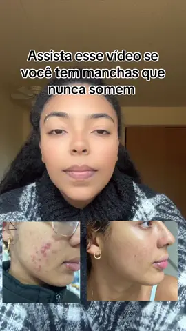 #pelemanchada #manchas #hiperpigmentacao #pelenegra #skincare #blackskin #blackskincareroutine #blackskincare #acne #acnehormonal #acnemulheradulta #pele 