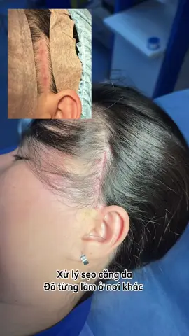 #xuhuong #sugery #operation #thammy #cangdamat #facelift #scar #sẹo 