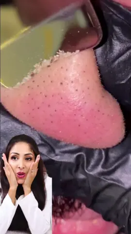 It's so satisfying but also very damaging 🙈. For skin of colour opt for salicylic acid leave on exfoliator plus a clay mask e.g. Dr V  TrioBlemish exfoliator plus The Ordinary clay mask.  Love Dr V #skincare  #blackheads 