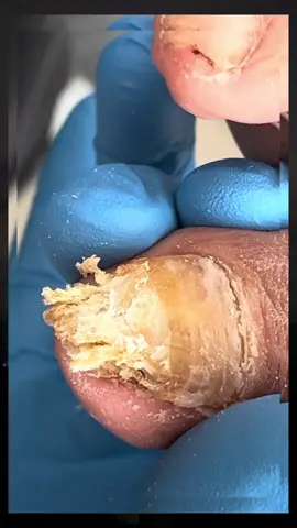 #toenailremoval #ingrowntoenail #pedicure #toenail #satisfyingvideo 