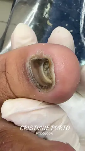 😱| O VÍDEO QUE    VOCÊS PEDIRAM ! VEJA A TRANSFORMAÇÃO . #podologia #viral #satisfyingvideo #satisfatório #peeling #nails #podologo #dormir 