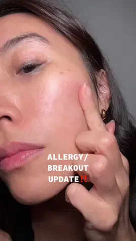 UPDATE: Allergy/Breakout Update #makeupreview #foundationreview 