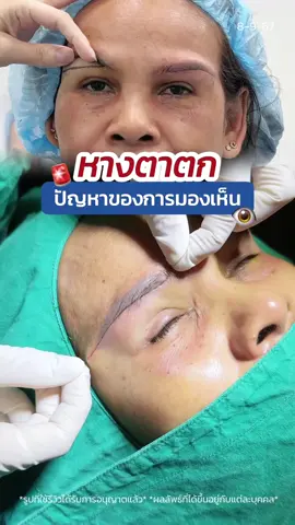 #หางตาตก กระทบการมองเห็นของคนแก่สูงวัย 👵🏻#ซ่อนแผลใต้คิ้ว #subbrowlift เทคนิค #ซ่อนไหมไร้รอยเข็ม 📍#skyclinic #หมอสกาย #ทําตาที่ไหนดี #ศัลยกรรมตา #จักษุแพทย์ #ทำตาคนสูงอายุ #สกายคลินิก #แก้หนังตาตก #ตาสองชั้น 