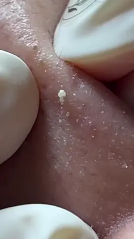 BLACKHEADS - Acne Treatment #squeezeyuk #acne #pimple #pimplepop #blackhead #satisfying #foryoupage #foryou  #تنظيف_بشره  #whiteheads #رؤوس_سوداء #عنايه_بالبشره #دهون 