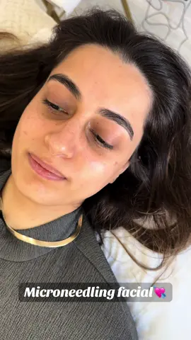 Microneedling facial session 1/4💘 Before and after 💘 We started of using a light pressure for my client to get used to the pen, to which will be built up over the 4 sessions for full effect💘 Disclaimer- must be 18+ for treatment. Redness of the skin is normal. #microneedling #microneedlingtherapy #microneedlingbeforeandafter #facialaesthetics #leicester #leicestercity #beauty #fyp #fy 