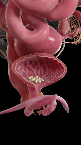 🪨 What Are Bladder Stones? 🪨  They're hard mineral deposits in the bladder, often caused by incomplete emptying or infections. Learn more about the symptoms!  #BladderStones #Urology #SciePro #EduTikTok #meded #Science #HumanAnatomy #3d #medstudent #medical