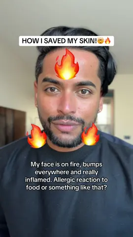 THIS SPRAY SAVED MY FACE! 🔥🤯🙏🏽 Yesterday I had a severe allergic reaction all over my face. I don’t know if it was the food or something else in the air. My face was inflamed, bumps all over and extreme redness. I haven’t had rosacea flareup in a few years, and I was really scared it might be that.  Lucky I was carrying my @Tower 28 Beauty SOS spray and I have heard great things about it. I tried it and it SAVED my skin! Redness subsided and the burninh went away. I am foing to a dermatologist as soon as I an back home. But I want to giove a shoutout to the spray for working! Addihg this to my makeup kit forever! ##sensitiveskin##rosacea##allergicreaction##inflammedface##tower28sosspray##tower28beauty ##skincare##BeautyTok