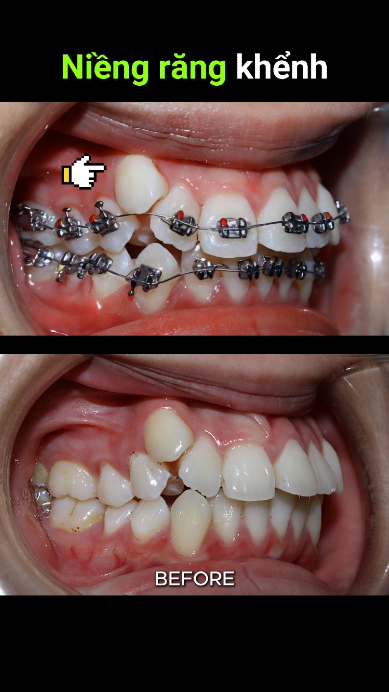Niềng răng khểnh, răng mọc chen chúc. Quá trình 40 tháng #niengrang #braces #orthodontist #dentist #nhakhoa 