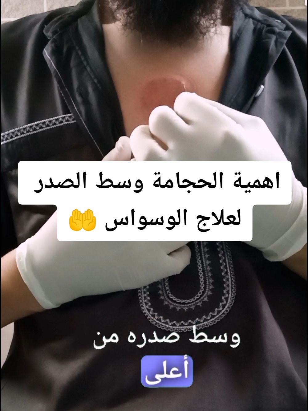 اهمية الحجامة وسط عظمة الصدر لعلاج الوسواس #الحجامة_النبوية #الحجام #حجامة #الحجامة_شفاء #الحجامة #cupping #الوسواس #hijam #الوسواس_القهري 