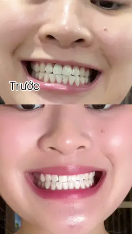 Trắng răng an toàn hiệu quả tại nhà cùng Smilee Extra White nha. #smilee #trangrangsmilee #smileeextra #smileeextrawhite #smileetrangrang #kittrangrang #kittrangrangsmilee #trangrang #trangrangtainha #trangrangsmileeHN