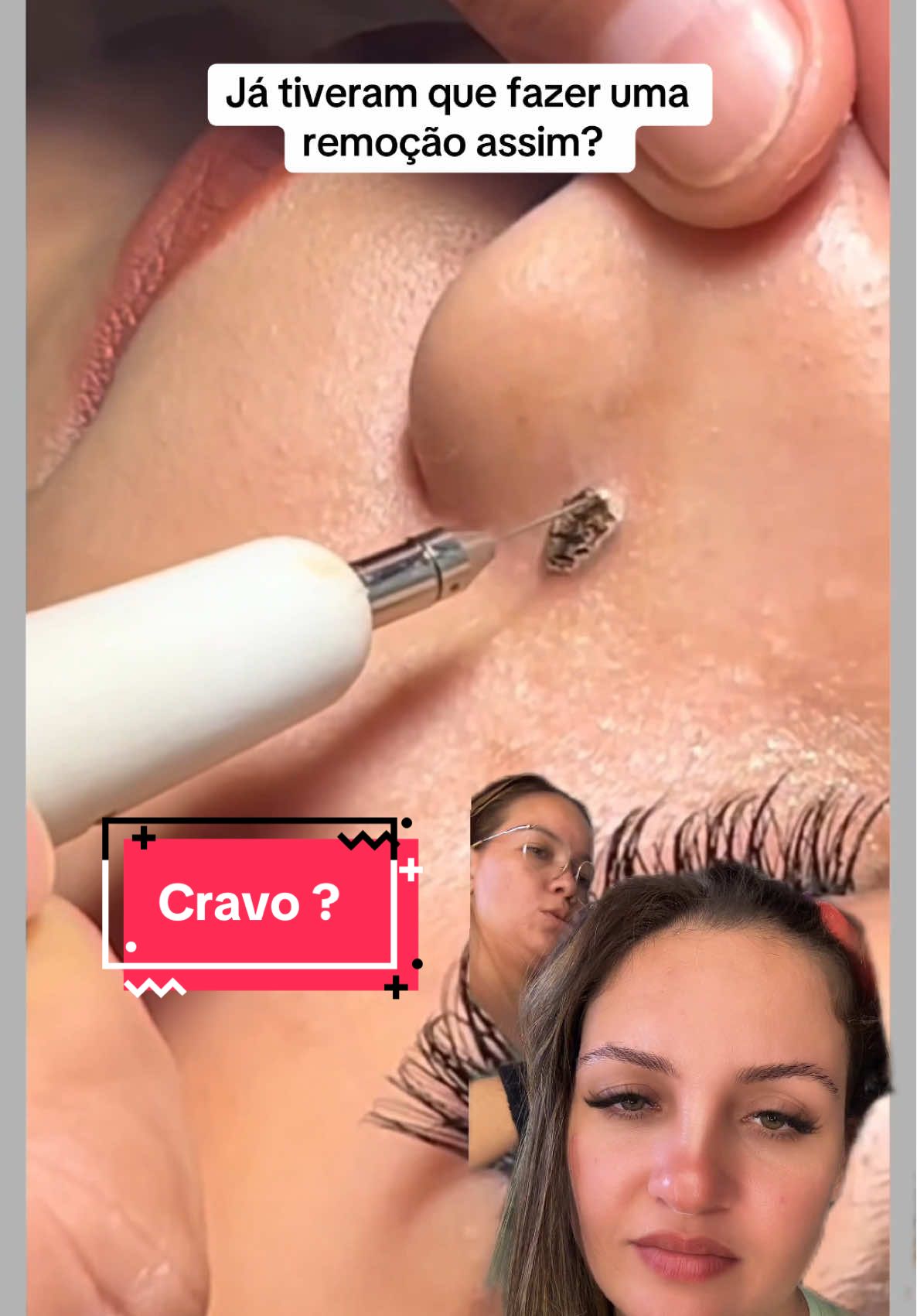 Eita que essa foi tensa #terapia #cravos #limpezasatisfatoria #satisfatório #reagindo 