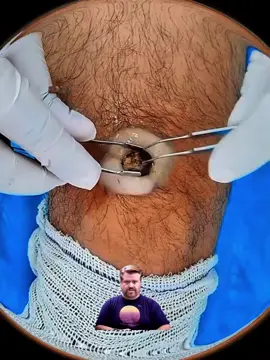#foreingobject #asmr #footacne ##removepimples #satisfyingvideo #foryou 