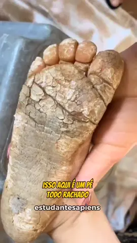 Pé rachado...