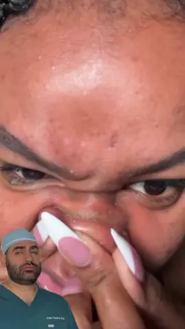 Reacting to someone squeeze sebum from their nose by pressing down hard may be satisfying to some, but it can actually cause harm! 🤦‍♂️ When you use your fingers to crush out sebum, you risk damaging delicate skin tissues, spreading bacteria, and potentially leaving scars.  A better approach? Use safe, dermatologist-approved methods that actually work and won’t put your skin at risk. For more information on how to safely remove sebum, visit Hazanyderm.com or check out the link in my bio! #SkinCareSafety #SebumFacts #ClearSkinTips #NoMoreAcne #HealthySkinJourney #AcneSolutions