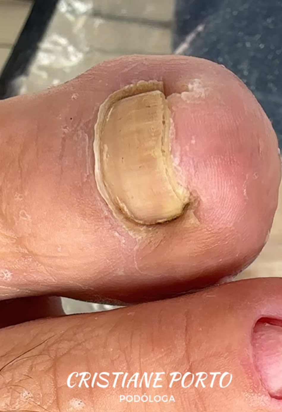 🤤| A LIMPEZA SATISFATÓRIA QUE VOCÊS AMAM ! . #satisfatorio #peeling #viral #podologia #dormir #fyp 