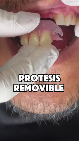 Protesis removible funcional, estetica y económica solo en #luxedentalcenter  Agenda tu cita: 📲 +593 99 484 5512 📍Av. De los Shirys y Naciones Unidas. Edif: Shirys Park Oficina 203 #ecuador🇪🇨 #quito #parati #protesisremovible #odontologo #odontologiaestetica #dientes #salud 