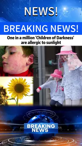 One in a million 'Children of Darkness' are allergic to sunlight #news #newstiktok #foryou #fyP #breakingnews #usa #worldnews 
