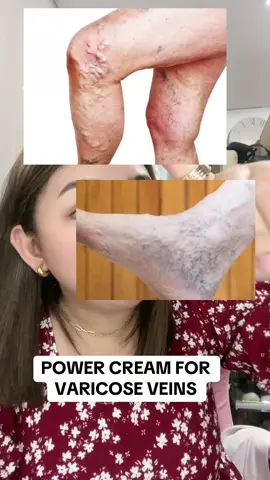 Replying to @BUDOL FINDS BY VAS MAY SOLUSYON NA SA MGA VARICOSE VEINS NYO! #powercreamforvaricose #varicoseveins #bmrspowercreamvaricoseveins #bmrspowercream #trending #foryou 