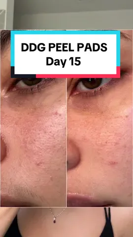 AD | These @Dr. Dennis Gross Skincare peel pads went viral for a reason, and now I understand why 🙂‍↕️ #ddgpartner #peelpads #acnetreatment #exfoliant #acne #texturedskin 