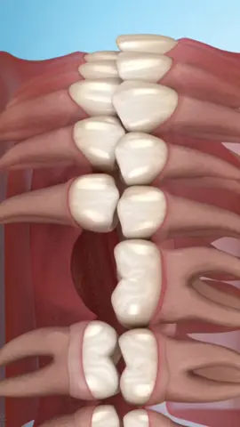تحرك الأسنان بسبب فقدان ضرس Tooth movement due to missing tooth #Surgery #طب_الأسنان #طب #متعة_وتعليم 