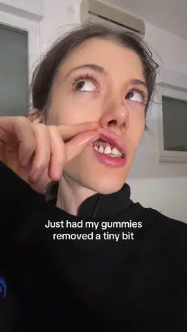 Dentist Reveals How To Fix Your GUMMY Smile! 😁🦷 #gums #teeth #dentist 