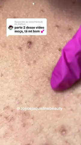 Respondendo a @eu_maduuv parte 2 🫶🏼 #foryoupage #fy #satisfyingvideo #tirandocravo #limpezadepele 