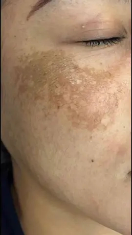 a receitinha caseira que fez minha pele sair disso para isso em apenas 7 dias.😱😱 #clarearpele #clarearmanchas #dicasdepele #manchasdeacne #melasma 