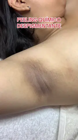 #peeling #axila #belleza #cosmiatra #paratii #fypシ゚viral #tiktokviral #cuidadodelapiel 