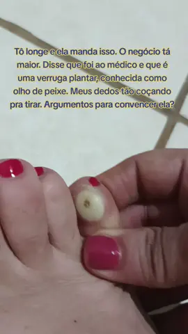 Genteeee, tô com os dedos coçando, mas como convencer minha mãe a me deixar tirar isso? O médico prescreveu apenas cetoprofeno e marcou retorno em 15 dias. #bichodepe #olhodepeixe #bichodeporco #viral_video #tiktokmemonetiza🥺 #bichodepé #verrugasplantares #verrugaplantar #videoviral #foryoupage 