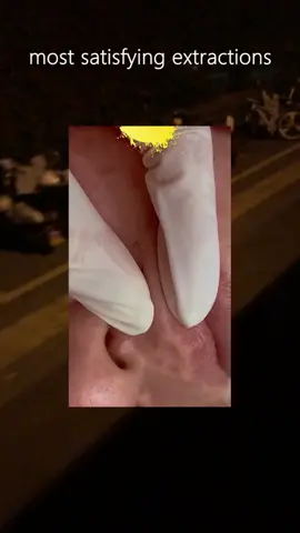 #pimple #acne #comfortable #blackhead #pimplepopper #viral #tiktok 