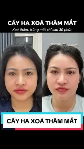QUẦNG THÂM MẮT NẶNG LÀ DO ĐÂU? 👉 Thâm mắt không chỉ xuất phát từ việc thiếu ngủ hay căng thẳng, mà còn có những nguyên nhân ẩn sâu khiến đôi mắt bạn trông mệt mỏi và thiếu sức sống.  🩻 Cấu trúc xương lộ rõ phần trũng mắt: Một số người có cấu trúc xương gò má và hốc mắt khiến vùng trũng mắt sâu hơn, tạo phần khuất bóng gây nên quầng thâm cơ địa.  👁️ Bọng thâm mắt sậm màu: Tăng sắc tố ở bọng mắt do tác động từ thói quen sinh hoạt không lành mạnh, stress kéo dài, hoặc làm việc nhiều ban đêm. Từ đó dẫn đến màu da vùng mắt tối sậm, tạo nên quầng thâm mắt. 👩‍⚕️ Phương pháp điều trị quầng thâm mắt tại NANA gồm 2 liệu trình chuyên sâu phù hợp với từng nguyên nhân giúp bạn giải quyết triệt để quầng thâm mắt.  ✔️ Cấy HA làm đầy hốc mắt trũng sâu ✔️ Meso huyết thanh giảm thâm, làm sáng vùng da dưới mắt.  👉 Đặc biệt là khách hàng nhà NANA sau lần điều trị đầu tiên đã mang lại hiệu quả giảm quầng thâm rõ rệt. Đặt lịch tư vấn ngay! ———————— 𝐍𝐀𝐍𝐀 𝐁𝐄𝐀𝐔𝐓𝐘 𝐂𝐋𝐈𝐍𝐈𝐂 - Top 1 chuyên sâu điều trị thâm mắt - Filler/ Botox cân chỉnh gương mặt - Nâng mũi chỉ cấu trúc công nghệ độc quyền - Căng bóng, trẻ hoá da & mesotherapy #nanabeautyclinic #filler #botox #mesotherapy #fillermoi #fillercam #thammatlaunam #dieutrithammat #thammatbamsinh 