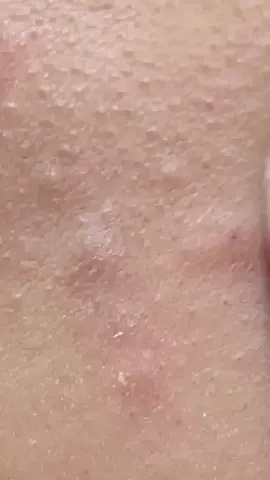 Acne Treatment - #squeezeyuk #acne #pimple #pimplepop #blackhead #satisfying #foryoupage #foryou  #تنظيف_بشره  #whiteheads #رؤوس_سوداء #عنايه_بالبشره #دهون 