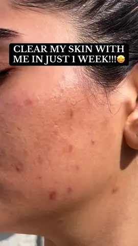✨🧡 #foryoupage #foryou #trending #skin #skincare #clearskin #acne #acneskin #asiangirl #desi 
