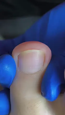 #toenailremoval #tiktokchallenge #foryou #viralvideo #thisis4u #ingrowntoenail #nails #toenails 