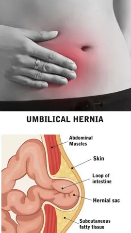 Cuidado! Dor na barriga pode ser uma Hérnia Umbilical.