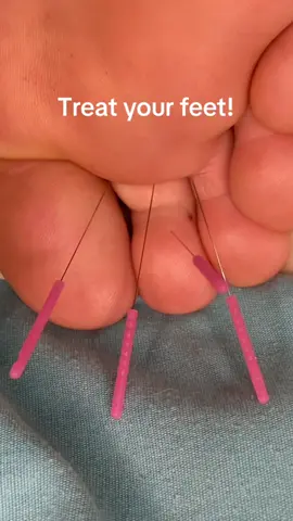 Acupuncture does an amazing job woth treating neuropathy, nerve pain in the toes and feet and even the pain from aMorton’s neuroma. Acupuncture is a lot less painful than a cortisone shot, so why not try it? #acupuncture #feet #walk #run #dance #shoes #toes #neuropathy #pain #holistic #healer 