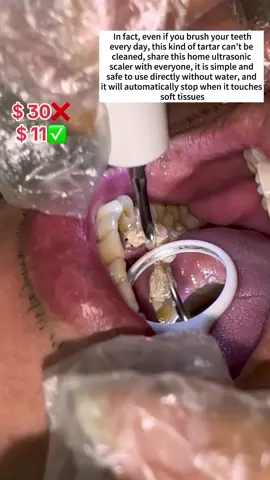 People who brush their teeth every day will accumulate a lot of tartar after a long time, so they should buy a set to go home and clean their mouth regularly at home. It is simple and safe to use. No water is required, and touching soft tissue will automatically stop. #halloweensale#freeshipping#flashsale#shopnow#linkinbio #oralcavity #oralhygiene#demtalstain#nbgrlvs#TikTokShop#tiktok#foryou #TikTokShopSummerSale #DealsForYouDays #falldealsforyou