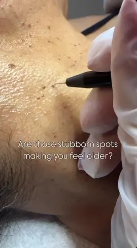 If you have age spots, sunspots, skin tags, sebaceous hyperplasia, seborrheic keratosis, or milia, we’re here to help you achieve clearer, healthier skin!  Contact us at info@skinbeautyandbeyond.com 905-842-8884 416-893-1831 #medispa #skintagremoval #aesthetics #medicalaesthetics #skincare #medispaoakville #sunspots #brampton #brownskin #sunspotremoval #skinclassic #liverspots #skintagsremoval #skintags #antiagingtreatment #skinhealth #flawlessskin #agespotremoval #keratosis #oakvilleontario #Skingoals #brownskinbeauty #sunspotremoval #agespotremoval