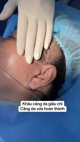 Căng da giấu sẹo đính cơ đa tầng  #sugery #operation #facelift #thammy #cangdamat #phauthuat 