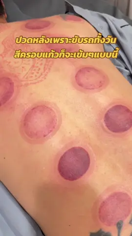 คนขับรถทั้งวัน วันละหลายชม. มักจะมีอาการปวดคอบ่าไหล่และหลังมาก และสีของรอยครอบแก้วในจุดที่ปวดมากมักจะมีสีเข้มแบบนี้เลยค่ะ #ปวดคอบ่าไหล่ #ปวดหลัง #ปวดสะโพกร้าวลงขา #ปวดเอว #ฝังเข็ม #ครอบแก้ว #cupping #ครอบแก้วแก้ปวด #แพทย์แผนจีน #หมอ #ฟาจินคลินิก 