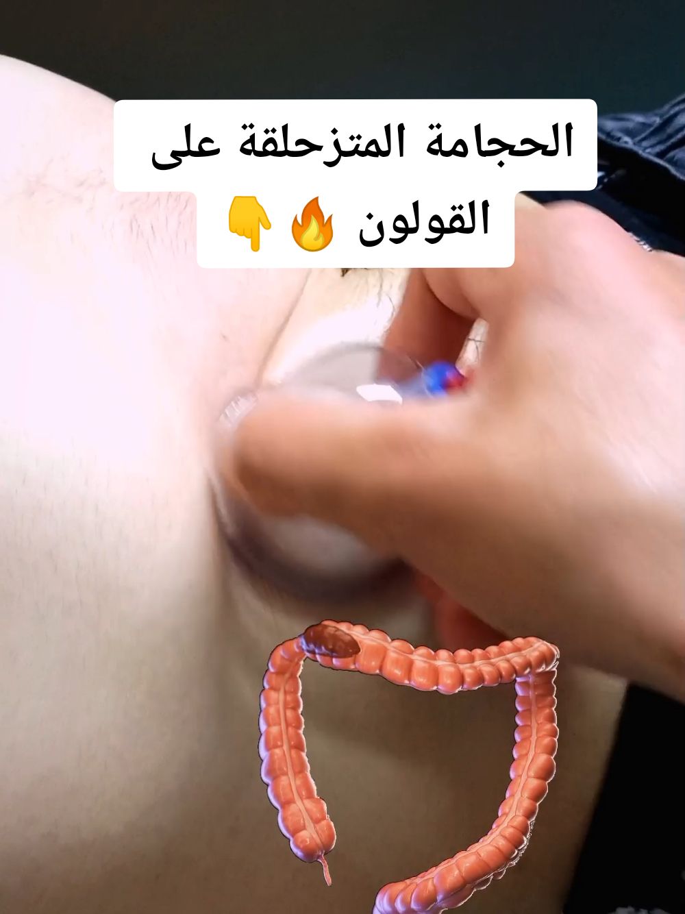 فوائد الحجامة المتزحلقة على القولون #الحجامة_النبوية #الحجامة_شفاء  #الحجامة_الطبية #حجامة_جافة #القولون_العصبي #حجامة #مساج  #الحجام #cupping #المساج #hijam #المغرب 