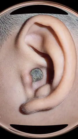 #foryou #pimple #earwaxremoval #earwax #blackhead #earwaxirrigation #earcleaning #