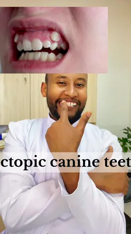 Do you have ectopic canine teeth? #drwondatir #benadental #canine #teeth #eruption #problem 