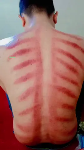 Kerokan: ritual penyembuhan yang tak lekang oleh waktu. Bye-bye, masuk angin!