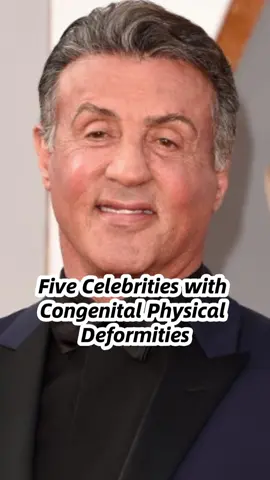 Five celebrities with congenital physical deformities  #entertainment #celebrity #famous #star #actors 
