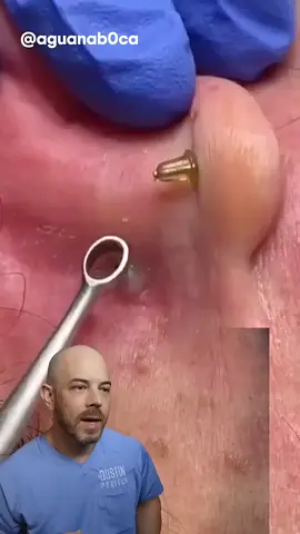 This is an iconic ear cyst extraction!  #doctor #satisfying #viral - #squeezeyuk #acne #pimple #pimplepop #blackhead #satisfying #foryoupage #foryou  #تنظيف_بشره  #whiteheads #رؤوس_سوداء #عنايه_بالبشره #دهون 